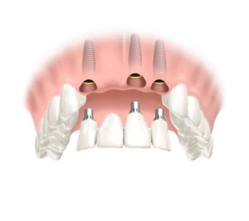 1. Fiksuotas protezas ant implantų