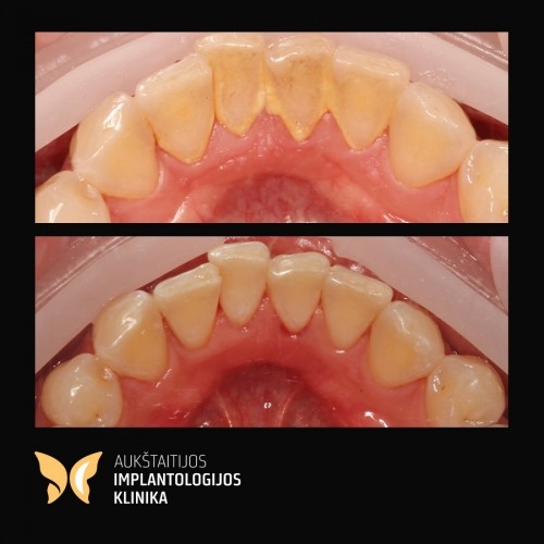 profesionali burnos higiena1